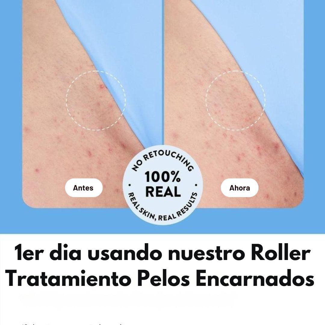 Roller Tratamiento - Pelos Encarnados - TodoBacano
